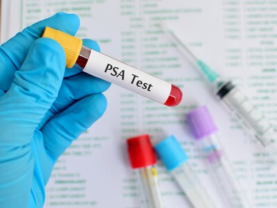 PSA teszt - Istenhegyi Géndiagnosztika